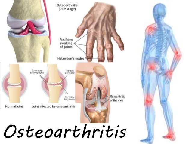 osteoarthritis 1 638